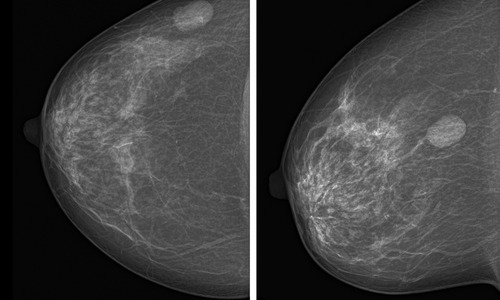 Czym jest włókniak i jak go leczyć ?