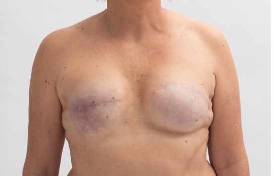 Leczenie blizn po operacji piersi – o czym warto pamiętać?